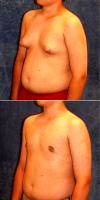 13 Year Old Man Treated With Male Breast Reduction By Dr. James A. Hoffman