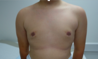 13 Year Old Man Treated With Male Breast Reduction With Doctor Edward I. Lee, MD, Houston Plastic Surgeon