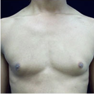 17 Year Old Man Treated With Male Breast Reduction By Doctor Kevin Dieffenbach, MD, Oahu Island Plastic Surgeon