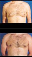 18-24 Year Old Man Treated For Male Breast Reduction By Dr Saeed Marefat, MD, Washington DC Plastic Surgeon