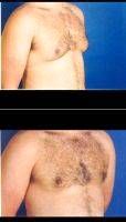 18-24 Year Old Man Treated For Male Breast Reduction Photos By Dr Saeed Marefat, MD, Washington DC Plastic Surgeon