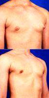 18-24 Year Old Man Treated With Gynecomastia Surgery - Male Breast Reduction With Dr Robert Caridi, MD, Austin Plastic Surgeon