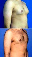 18-24 Year Old Man Treated With Laser Liposuction For Gynecomastia By Dr Saul Lahijani, MD, Los Angeles Physician