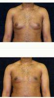 18-24 Year Old Man Treated With Male Breast Reduction By Doctor Andrew M. Lofman, MD, FACS, Detroit Plastic Surgeon (1)