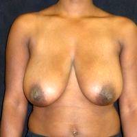 18-24 Year Old Man Treated With Male Breast Reduction By Doctor Andrew M. Lofman, MD, FACS, Detroit Plastic Surgeon (2)