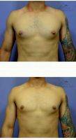 18-24 Year Old Man Treated With Male Breast Reduction By Doctor Carlos O. Chacon, MD, MBA, Chula Vista Physician