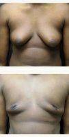 18-24 Year Old Man Treated With Male Breast Reduction By Doctor John Paletta, MD, Savannah Plastic Surgeon