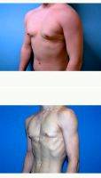 18-24 Year Old Man Treated With Male Breast Reduction By Doctor Landon Pryor, MD, FACS, Rockford Plastic Surgeon