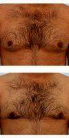 18-24 Year Old Man Treated With Male Breast Reduction By Dr Paul Vitenas, Jr., MD, Houston Plastic Surgeon