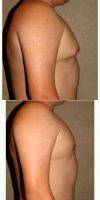 18-24 Year Old Man Treated With Male Breast Reduction By Dr. Babak Dadvand, MD, Los Angeles Plastic Surgeon