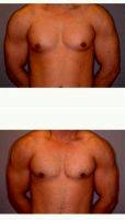 18-24 Year Old Man Treated With Male Breast Reduction By Dr. David K. Ward, MD, Surrey Plastic Surgeon