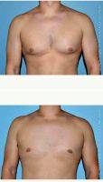 18-24 Year Old Man Treated With Male Breast Reduction By Dr. Jose Perez-Gurri, MD, FACS, Miami Plastic Surgeon