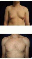 18-24 Year Old Man Treated With Male Breast Reduction By Dr. Richard Zienowicz, MD, Providence Plastic Surgeon