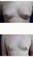 18-24 Year Old Man Treated With Male Breast Reduction With Doctor Elliott B. Lavey, MD, Danville Plastic Surgeon