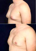 18-24 Year Old Man Treated With Male Breast Reduction With Dr Michael Law, MD, Raleigh-Durham Plastic Surgeon