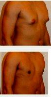 18-24 Year Old Man Treated With Male Breast Reduction With Dr Robert Kratschmer, MD, Houston Plastic Surgeon