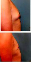 18-24 Year Old Man Treated With Male Breast Reduction With Dr Sean T. Lille, MD, Scottsdale Plastic Surgeon