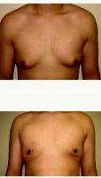 18-24 Year Old Man Treated With Male Breast Reduction With Dr Stacy Peterson, MD, Wichita Plastic Surgeon