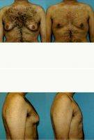 18-24 Year Old Man Treated With Male Breast Reduction With Dr. Afshin Parhiscar, MD, Bay Area Plastic Surgeon