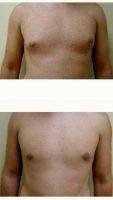 18-24 Year Old Man Treated With Male Breast Reduction With Dr. Andrew P. Amunategui, MD, Miami Plastic Surgeon