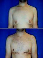 18-24 Year Old Woman Treated With Severe Gynecomastia Surgery By Dr Tom J. Pousti, MD, FACS, San Diego Plastic Surgeon