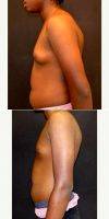 18 Year Old Man Treated With Male Breast Reduction By Dr Yoav Barnavon, MD, FACS, Hollywood Plastic Surgeon