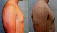 18-year-old Male With Gynecomastia Receives Breast Reduction By Dr. Jeffrey Rockmore, MD, Albany Plastic Surgeon