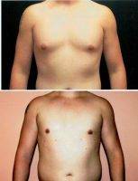 19 Year Old Man Treated With Male Breast Reduction By Doctor Fara Movagharnia, DO, FACOS, Atlanta Plastic Surgeon