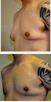 19 Year Old Man Treated With Male Breast Reduction By Dr. Jack Peterson, MD, Topeka Plastic Surgeon