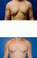 19 Year Old Man Treated With Male Breast Reduction With Doctor Sugene Kim, MD, FACS, Houston Plastic Surgeon