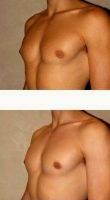 20 Year Old Man Treated With Male Breast Reduction By Doctor Babak Dadvand, MD, Los Angeles Plastic Surgeon
