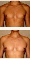 20 Year Old Man Treated With Male Breast Reduction By Doctor Babak Dadvand, MD, Los Angeles Plastic Surgeon