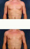 20 Year Old Man Treated With Male Breast Reduction By Doctor James F. Boynton, MD, FACS, Houston Plastic Surgeon