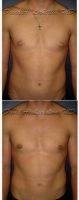 20 Year Old Man Treated With Male Breast Reduction With Doctor David A. Lickstein, MD, Palm Beach Gardens Plastic Surgeon