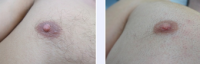 21 Year Old Male Nipple Reduction Patient With Dr. Adrian Richards, MBBS, MSc, FRCS (Plast), London Plastic Surgeon