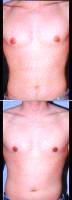 21 Year Old Man Treated For Male Breast Reduction With Doctor Steven J. Smith, MD, Knoxville Plastic Surgeon