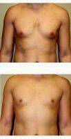 21 Year Old Man Treated With Male Breast Reduction With Dr Bryan C. McIntosh, MD, Bellevue Plastic Surgeon