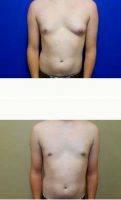 21 Year Old Man Treated With Male Breast Reduction With Dr William L. Reno, III, MD, Hattiesburg Plastic Surgeon