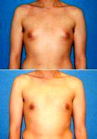 22 Year Old Male Breast Reduction - Gynecomastia With Dr Kyle Song, MD, Orange County Plastic Surgeon