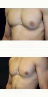 22 Year Old Male With Gynecomastia Treated With Direct Excision Of Breast Tissue Only By Dr Steven Turkeltaub, MD, Scottsdale Plastic Surgeon