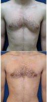 22 Year Old Man Treated With Male Breast Reduction By Dr Matthew S. Kilgo, MD, Long Island City Plastic Surgeon