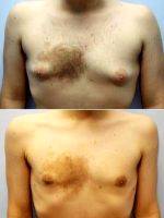 22 Year Old Man Treated With Male Breast Reduction With Dr. Raymond Jean, MD, Philadelphia Plastic Surgeon