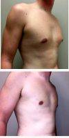 22 Year Old Man Treated With Male Breast Reduction With Dr. Shaun Parson, MD, Phoenix Plastic Surgeon