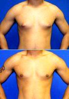22 Year Old Man With Gynecomastia Treated With Male Breast Reduction By Dr Daniel Brown, MD, FACS, La Jolla Plastic Surgeon