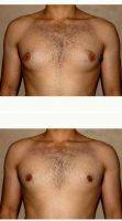 23 Year Old Man Treated With Male Breast Reduction By Doctor Babak Dadvand, MD, Los Angeles Plastic Surgeon