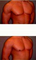 23 Year Old Man Treated With Male Breast Reduction By Dr. David K. Ward, MD, Surrey Plastic Surgeon (1)