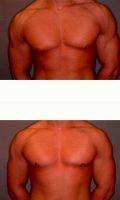 23 Year Old Man Treated With Male Breast Reduction By Dr. David K. Ward, MD, Surrey Plastic Surgeon
