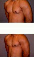 23 Year Old Man Treated With Male Breast Reduction By Dr. David K. Ward, MD, Surrey Plastic Surgeon (2)