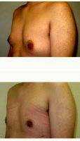 23 Year Old Man Treated With Male Breast Reduction With Doctor Joon Y. Choi, MD, Orange Plastic Surgeon