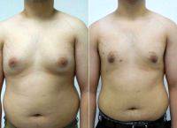 23 Year Old Man Treated With Male Breast Reduction With Dr. Sam Gershenbaum, DO, Aventura Plastic Surgeon